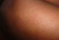 5 Cara Mengatasi Anak Terserang Campak (ilustrasi pixabay) 